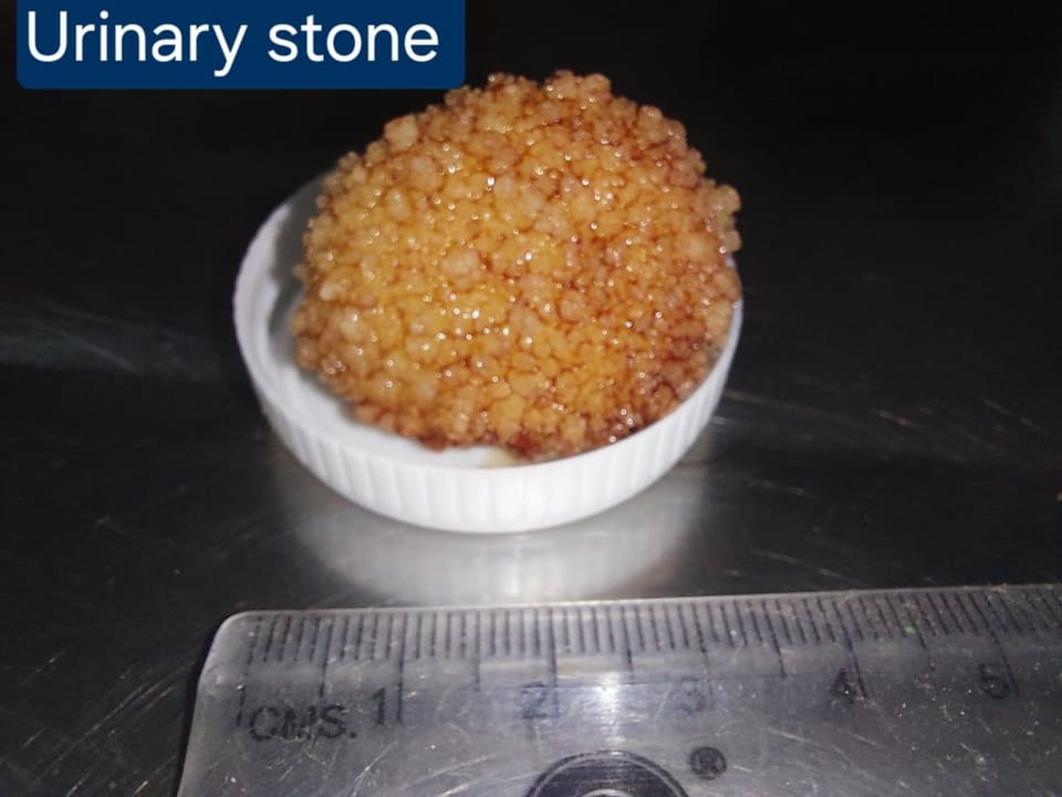 Urinary stones removed during surgery, measured against a ruler